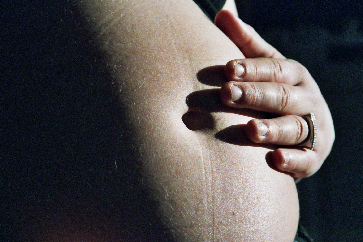 como evitar estrias durante embarazo